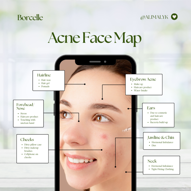 ACNE FACE MAP BY ALIMALYK